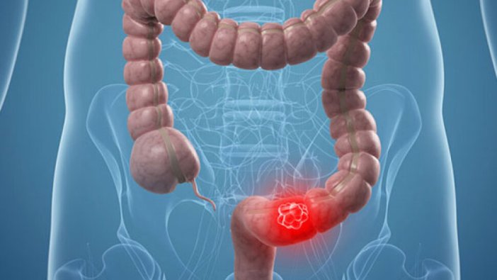 Kalın bağırsak kanseri tarama programları ile önlenebiliyor