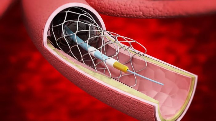 Stent ne işe yarar?