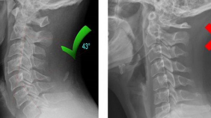 Boyun düzleşmesi neden olur, tedavisi var mı?