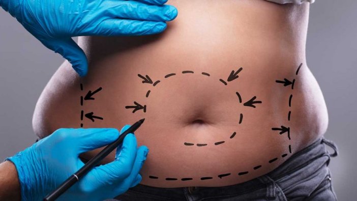 Liposuction zararlı mı, faydalı mı?