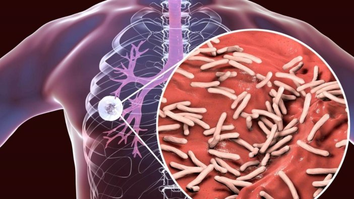 Dikkat uzun süren ve uyutmayan öksürükler tüberküloz belirtisi olabilir