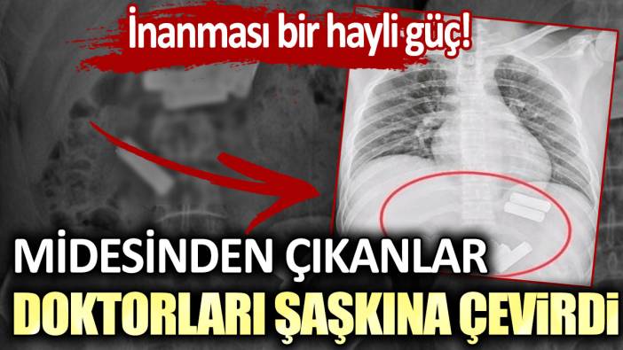 İnanması bir hayli güç! Midesinden çıkanlar doktorları şaşkına çevirdi