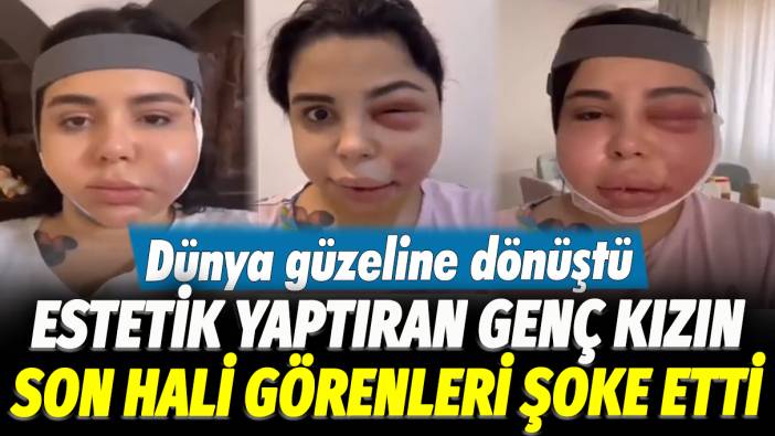 Estetik yaptıran genç kızın son hali görenleri şoke etti: Dünya güzeline dönüştü