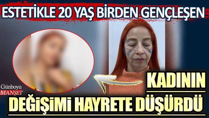 Estetikle 20 yaş birden gençleşen kadının değişimi hayrete düşürdü