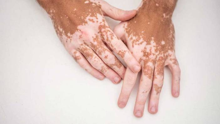 Stres ve travmalar vitiligo hastalığını tetikliyor