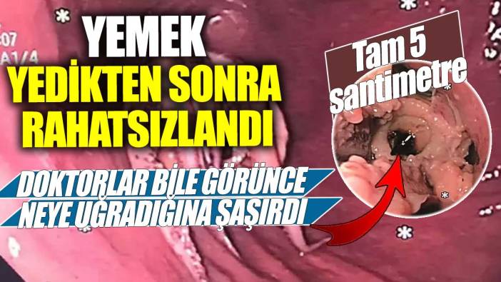 Yemek yedikten sonra rahatsızlandı... Doktorlar bile görünce neye uğradığına şaşırdı!  Tam 5 santimetre!