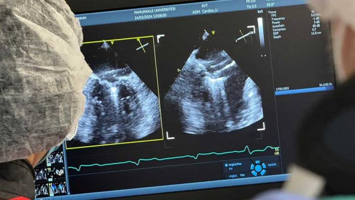 Denizli’de ilk defa ameliyatsız mitral kapak yetmezliği tamiri yapıldı