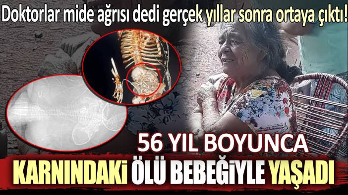 56 yıl boyunca karnındaki ölü bebeğiyle yaşadı: Doktorlar mide ağrısı dedi gerçek yıllar sonra ortaya çıktı!