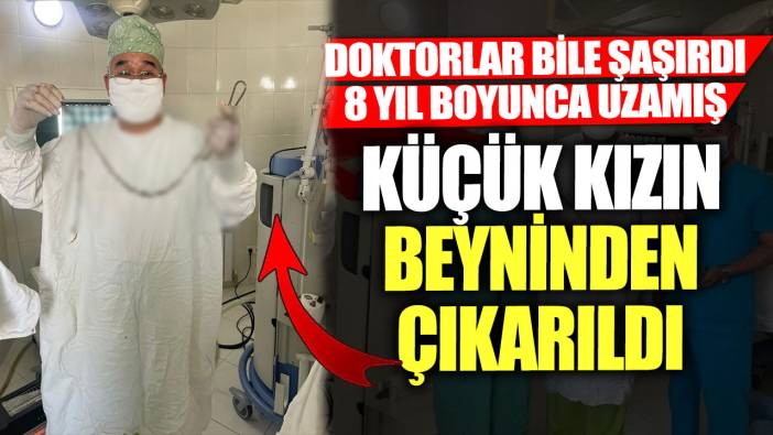 Doktorlar bile şaşırdı! 8 yıl boyunca uzamış... Küçük kızın beyninden çıkarıldı