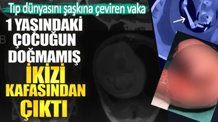 Tıp dünyasını şaşkına çeviren vaka. 1 yaşındaki çocuğun doğmamış ikizi kafasından çıktı