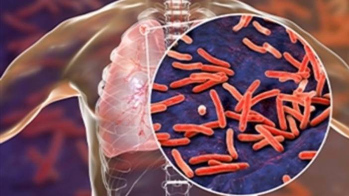 Rekor seviyedeki verem salgını uzmanları şaşkına çevirdi: Tedavi edilmezse ölümcül olabilir